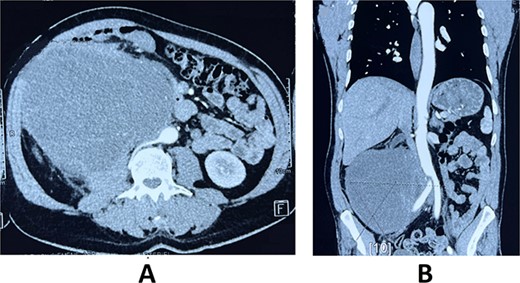 Axial (A) and frontal (B) view of Computed tomography scan showing a large right retroperitoneal solid mass, with lobulated thickened wall measuring 190 × 140 × 120 mm, heterogeneously enhancing, displacing anteriorly duodenal loops, laterally the right colon, medially the inferior vena cava and abdominal aorta.
