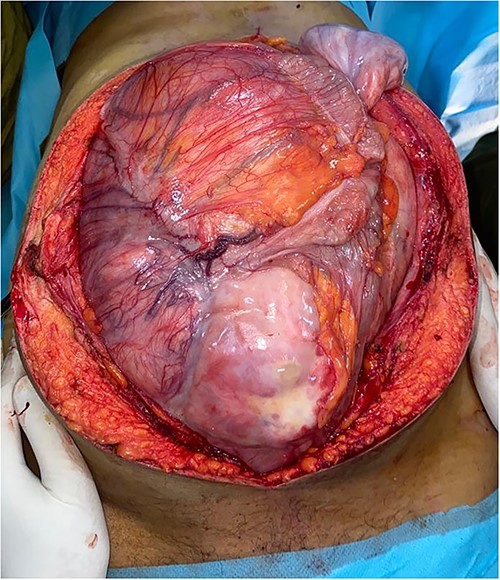 Preoperative view of the large lobulated mass occupying largely the abdominal cavity.