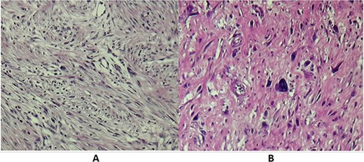 (A) Microscopic examination showing spindle cells with elongated hyperchromatic nuclei and arranged in interlacing bundles of (HE X 200). (B) Tumor cells showing nuclear atypia and eosinophilic cytoplasm (HE X 400).