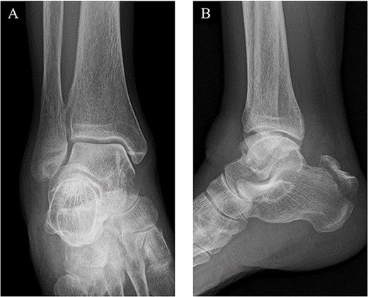 Plain radiographs of the right ankle showed no abnormal findings in (A) an anteroposterior view, but an avulsion fracture of the calcaneal tuberosity (B) a lateral view.