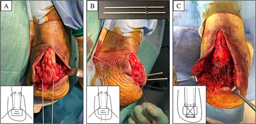 (A) The distal part of the Achilles tendon was sutured by SLLS technique using USP 5 braided polyethylene and polyester suture thread. (B) Next, two 1.6-mm diameter ring pins were parallelly inserted from the distal posterior part to the anterior part of the calcaneus body. (C) The bone fragment was anatomically reduced, and the suture ends were passed through the rings from inside and outside, respectively. The suture threads were crossed above the calcaneal tuberosity and were tied on the ventral side of the Achilles tendon.