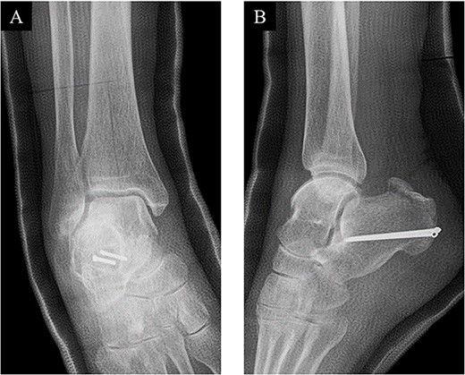 Postoperative (A) anteroposterior and (B) lateral ankle radiographs. The bone fragment was reduced and fixed using the combination of SLLS technique and ring pins.