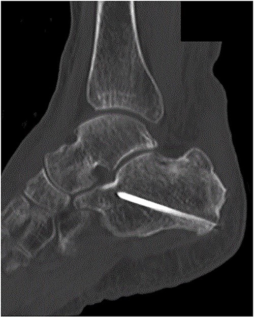 At 3 months after the surgery, non-contrast CT showed complete bone union in a sagittal view.