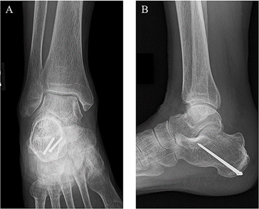 At 2 years after the surgery, plain radiographs of the right ankle showed complete bone union without the deformity of the fracture site and the backing out of the implants in (A) anteroposterior and (B) lateral views.