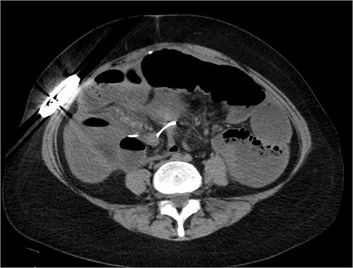 CT image showing dilated small bowel with gastric stimulator wire seen looping around one of the small bowel loops suggesting possible strangulation.