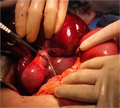 Gangrenous bowel with gastric pacemaker wire wrapped around the base of the mesentery.