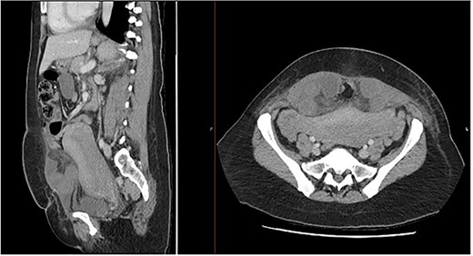 Sagittal and axial CT abdomen and pelvis slices demonstrating oedematous small bowel loops herniating between layers of the anterior abdominal wall.