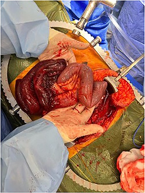 Midline laparotomy demonstrating ischaemic ileum.