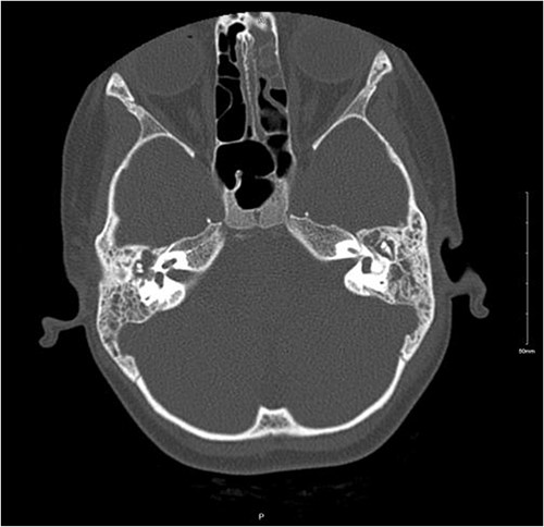 Non-enhanced axial CT scan of temporal bone showing bony remodeling suggestive of chronic otomastoiditis.