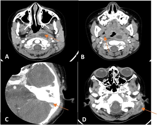Enhanced CT scan of the temporal bones and neck showing (A) a left parapharyngeal space fluid collection with enhancing walls, (B) a small right parapharyngeal collection with minimally enhancing walls, (C) an intracranial extension of mildly enhancing lesion to subdural space and (D) a left mastoid bone showing lateral wall cortical disruption with adjacent retro-auricular irregular collection with enhancing walls.