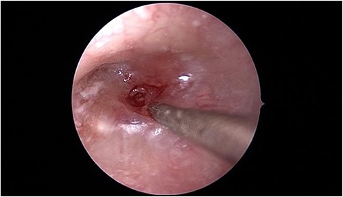 Intraoperative endoscopic view of the left middle ear cavity filled with granulation tissue.