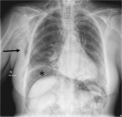 Chest X-ray Day 2 post-operatively, showing extensive subcutaneous emphysema on the right (arrow) and subdiaphragmatic free gas (*) concerning for perforated viscus.