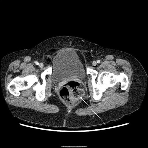 Axial CT showing rectal perforation (arrow).