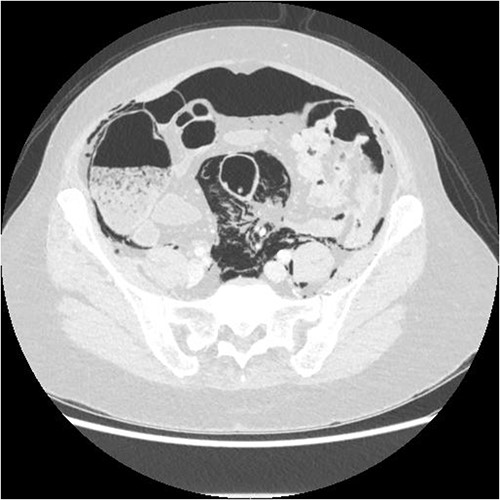 Axial CT showing extensive intra- and extraperitoneal free gas.