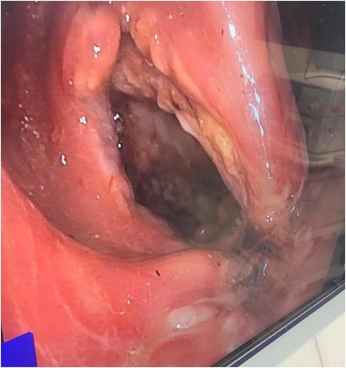Flexible sigmoidoscopy image of full thickness rectal perforation.
