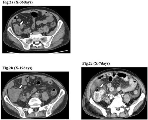 CT image of the ileocecal diverticulitis. The image shows that ileocecal diverticulitis (arrows) has occurred three times (a–c) until the diverticular perforation.
