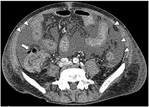 CT image of ascites (arrowheads) and free air (arrow).