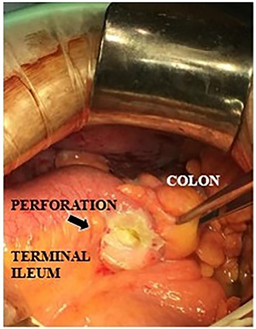Intraoperative findings of a terminal ileal perforation on the mesenteric side (arrow).