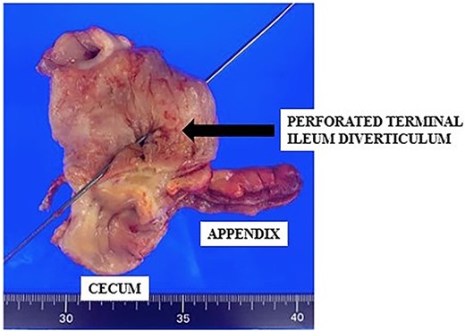 Resected specimen of ileocecum with the perforation of the terminal ileum (arrow).