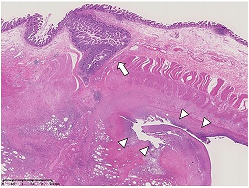Specimen cross-section and microscopic examination (hematoxylin and eosin staining) of the terminal ileal diverticula (arrow) and perforation site (arrowheads).