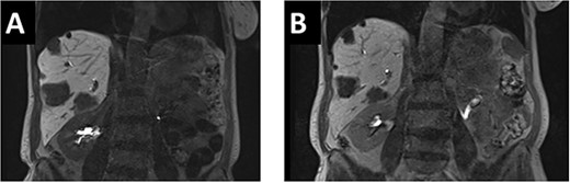 (A). In the initial pre-chemo MRI of the liver multiple liver metastases in all liver segments could been seen. The largest were in segments II/III (26 mm), V (37 mm) and segment VI (40 mm). (B) After 12 cycles of chemotherapy a size reduction of liver metastasis up to 12% could be achieved. The metastases in liver segments V and VI decreased from 43 to 38 mm and from 37 to 33 mm.