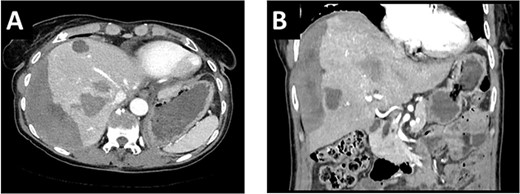 (A/B) CT-scan showing a large intrahepatic hematoma after liver biopsy on the right side.