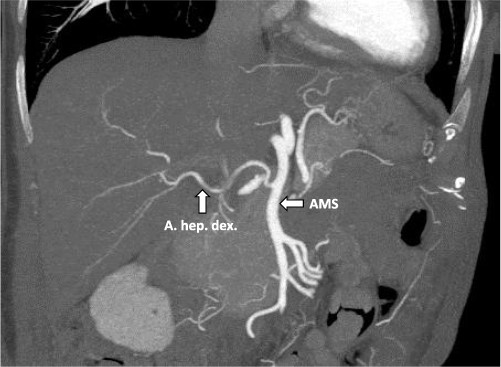 CT-angiography showing the accessory right hepatic artery originating from the superior mesenteric artery.