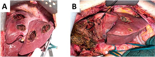 (A). Left hemiliver after cleaning of the FLR with five atypical liver resections. (B) Remaining left hemiliver after completion right hemihepatectomy during ALPPS step 2.