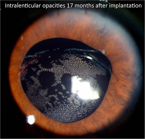 Slit lamp photograph illustrating lenticular opacities in patient 1.
