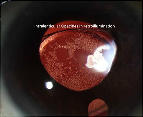 Slit lamp photograph highlighting lenticular opacities on retro-illumination.