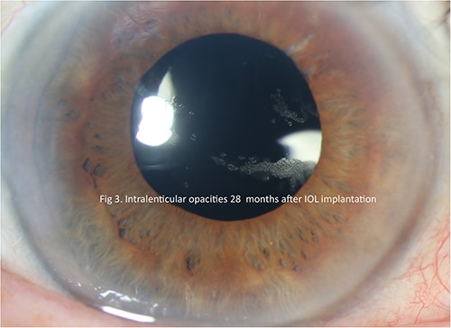Slit lamp photograph illustrating lenticular opacities in patient 2.