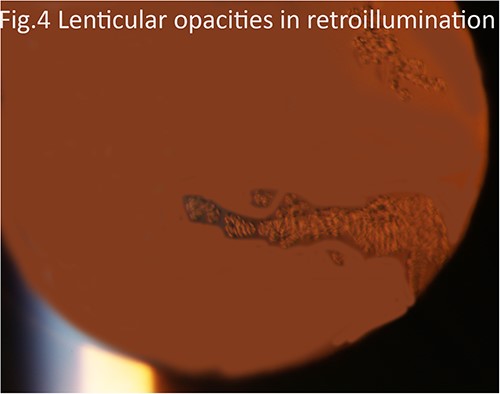 Slit lamp photograph highlighting lenticular opacities on retro-illumination.
