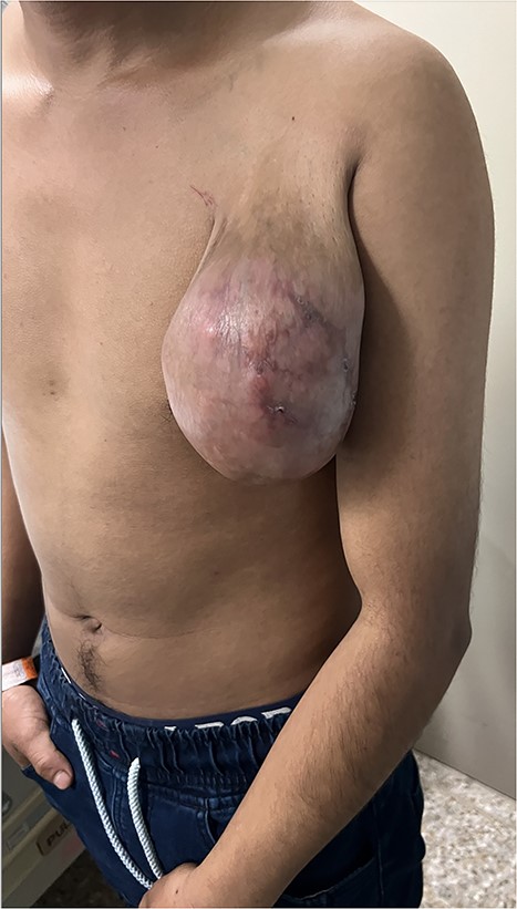 Left infraclavicular mass with small ulcerative lesions extending to the mid-arm level.