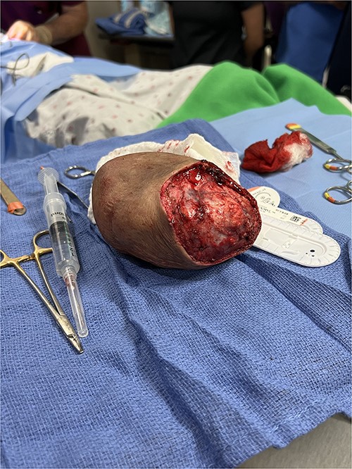 Resected left infraclavicular mass with 2 cm wide margins.