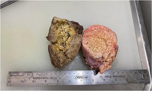Incised mass revealing yellowish areas with a friable calcified appearance and solid uncalcified whitish areas consistent with foreign body reaction.