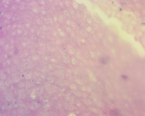 Tumor microscopy revealing basophilic cells that mimic the stratus basalis interspersed with characteristic ghost cells.