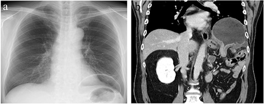 Chest X-ray (CXR) and contrast-enhanced computed tomography (CT). (a) CXR showing gastric gas shadow projected to left hemithorax. (b) CT showing a diaphragmatic hernia in the coronal plane.