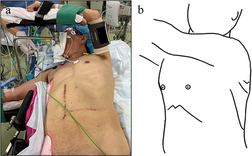 Surgical position and ports setting. (a) Right semi-lateral decubitus position. (b) Four ports in total. One 12-mm port at the left 4th intercostal space. Three 5 mm ports at the left fifth, sixth and eighth intercostal space.