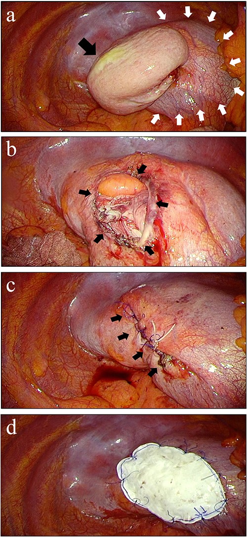 Thoracoscopic finding and repair of diaphragmatic hernia. (a) Incarcerated stomach (black arrow) from diaphragm (white arrows) was fornix without ischemia. (b) The defect on the diaphragm was 40 × 30 mm after adhesions was removed (black arrows). (c) Sewing the hernia defect with 2-0 polypropylene suture. (d) Reinforcement after hernia closure. An expanded polytetrafluoroethylene mesh sized 90 × 60 mm was fixed to cover the suture line and tendon part of the diaphragm.