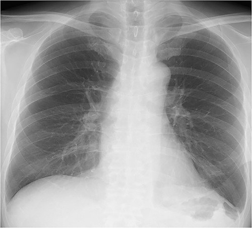 Chest X-ray after surgery showing no recurrence.