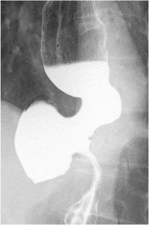 Esophageal fluoroscopy (before dilation). There was a 5 cm-sized diverticulum in the lower esophagus just above the eruption.
