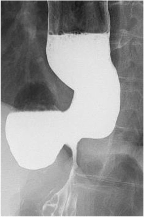 Preoperative esophageal fluoroscopy (after dilation). There was no significant change compared to the pre-expansion period.