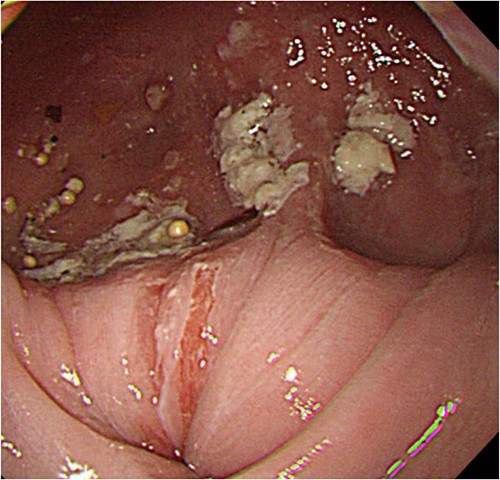 Upper digestive tube endoscopy. The esophagus just below the diverticulum was stenotic, and there was residue accumulation in the diverticulum.