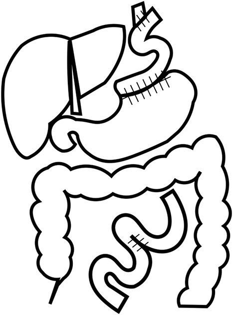 Reconstruction. The patient underwent lower esophagogastric resection and interstitial jejunal reconstruction due to poor coloration of the vault capsule by Nissen’s method.