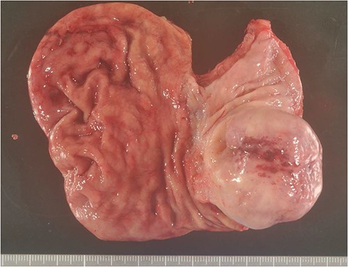 Excised specimen. Diverticulum-like cyst formation was observed in the esophago-gastric junction due to esophageal mucosal dilatation and entrapment of the esophageal mucosa associated with outer membrane adhesion.