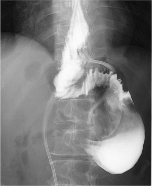 Postoperative esophageal fluoroscopy. No stenosis findings or stagnation of contrast media was observed.