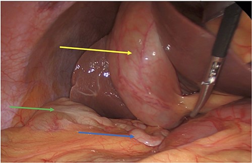 Acute cholecystitis (yellow arrow) with the high riding cecum (green arrow) and subhepatic appendix (blue arrow).