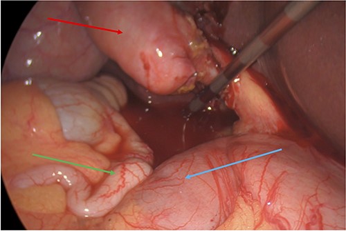 Subhepatic appendix (green arrow) in relation to the duodenum (blue arrow) and gallbladder (red arrow).