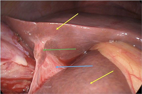 Incidental finding of a subhepatic bridge (blue arrow) with liver parenchymal tissue (green arrow) joining the left and right lobes of the liver (yellow arrows).