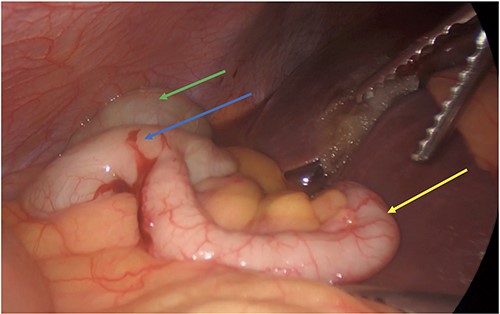 Post cholecystectomy with the subhepatic appendix overlying the left lobe of the liver (yellow arrow) and the cecum (blue arrow) next to the hepatic flexure (green arrow).